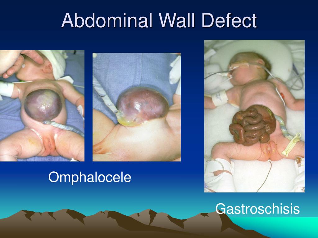 Bowel obstructions in children