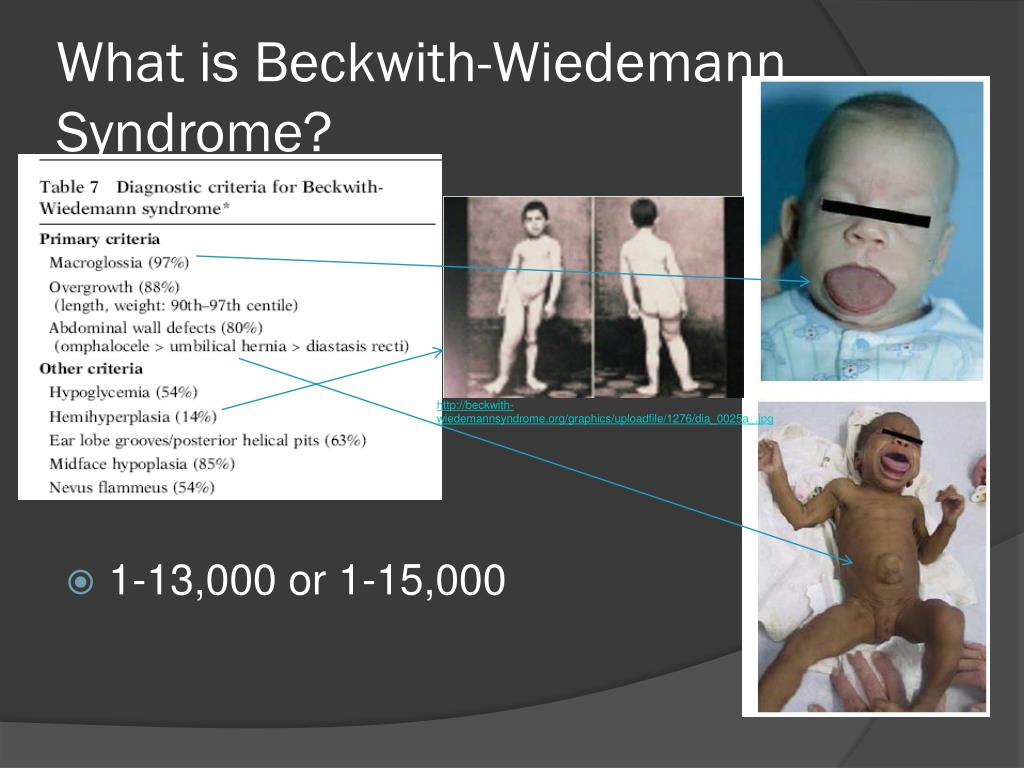 Beckwith wiedemann syndrome photos