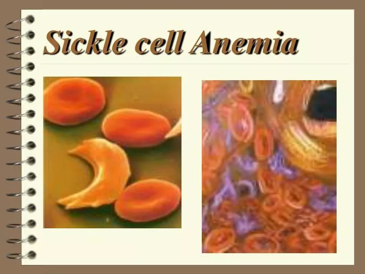 Sickle Cell Anemia ATI Template Sickle Cell Anemia ATI Template