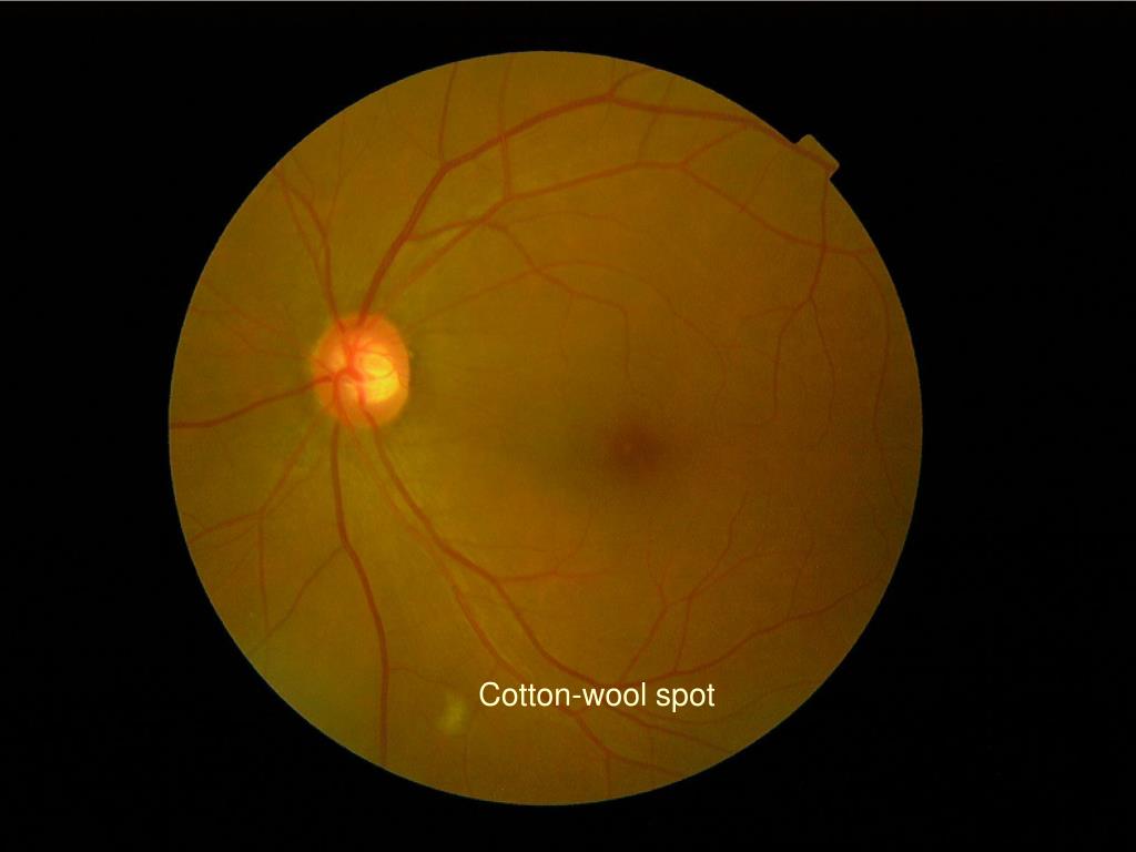 Cotton Eye Problem PPT - The International Classification of Diabetic Retinopathy ...