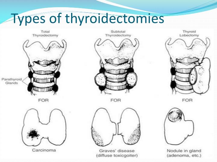 ppt-subtotal-thyroidectomy-powerpoint-presentation-id-2761031