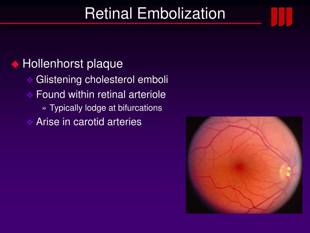 Hollenhorst Plaque Carotid Artery Hollenhorst Plaque Carotid Artery