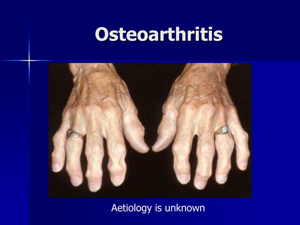 PPT Management of Rheumatoid arthritis, Osteoarthritis & Gout