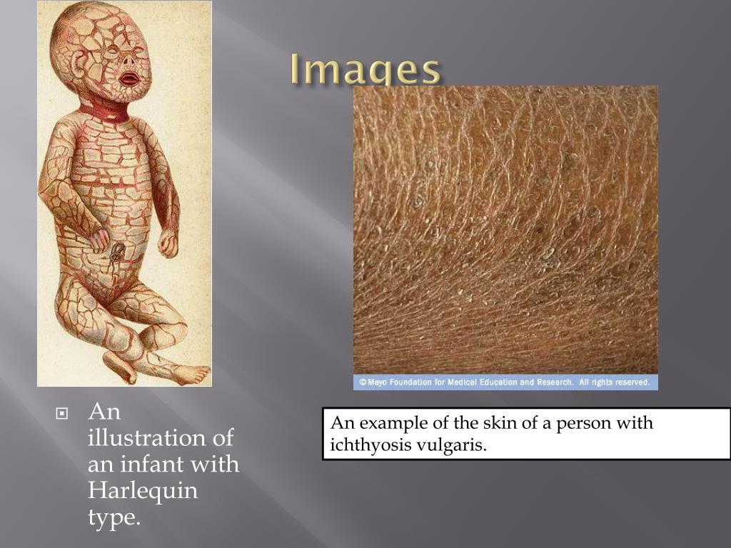 PPT Ichthyosis PowerPoint Presentation Free Download ID 2776261 PPT Ichthyosis PowerPoint Presentation Free Download ID 2776261