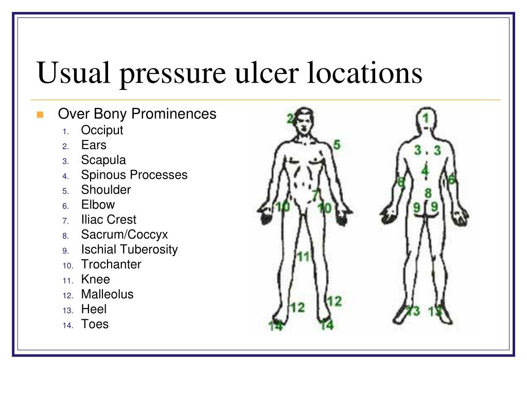 Pressure Ulcer Positioning Images Photos Mungfali pressure-ulcer-positioning-images-photos-mungfali