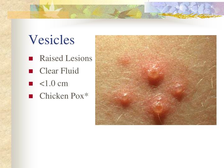 PPT - Rashes and the School Nurse PowerPoint Presentation - ID:2777002