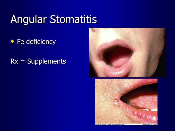 PPT - Extra GI Manifestations of IBD PowerPoint Presentation - ID:2777829