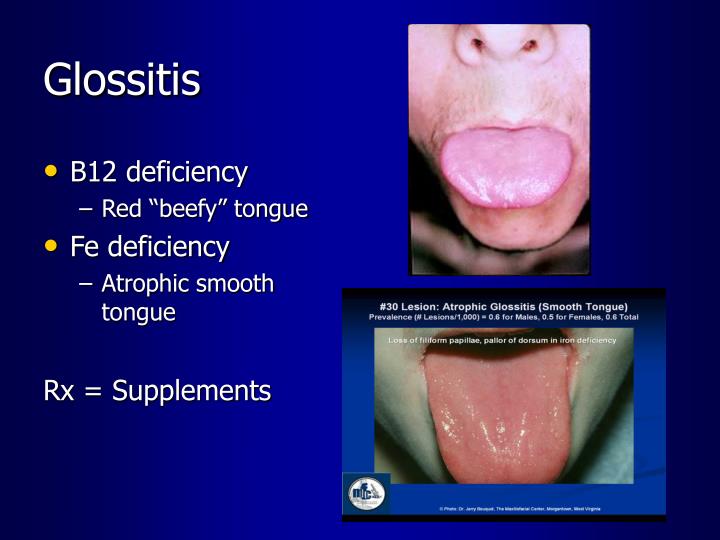 Vitamin B12 Deficiency And Burning Tongue At Amber Polk Blog