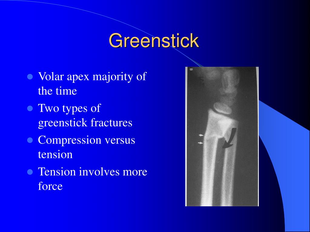 PPT Pediatric Distal Radial Fractures PowerPoint Presentation Free 