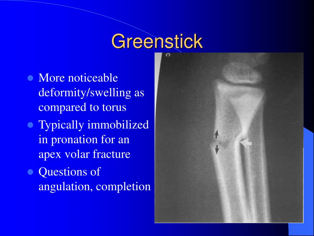 Greenstick Fracture Treatment