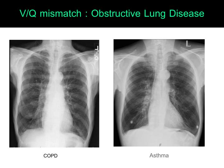 PPT - Arterial Blood Gas Interpretation PowerPoint Presentation - ID ...
