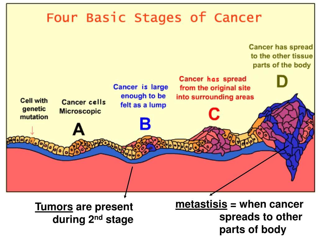 Stages of cancer. Стадий развития опухолей. Стадии развития онкологии. Раковая опухоль стадии развития.