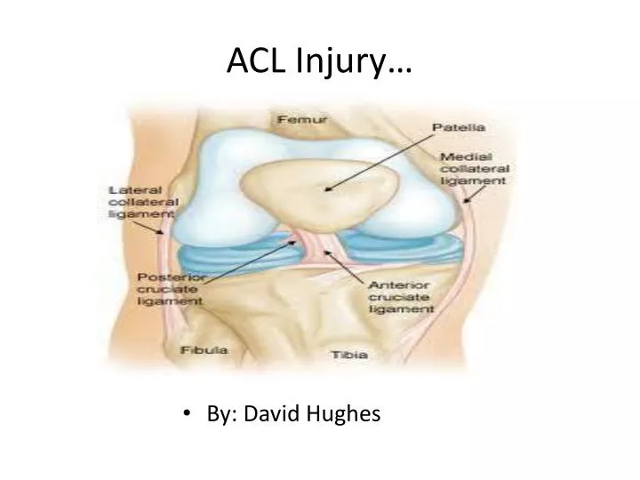 an analysis of the issue of prevention and treatment of acl injuries Acl injury prevention training focuses on younger athletes 2014 prevention of acl injuries targets one response to acl injury prevention training focuses on. an analysis of the issue of prevention and treatment of acl injuries Acl injury prevention training focuses on younger athletes 2014 prevention of acl injuries targets one response to acl injury prevention training focuses on.