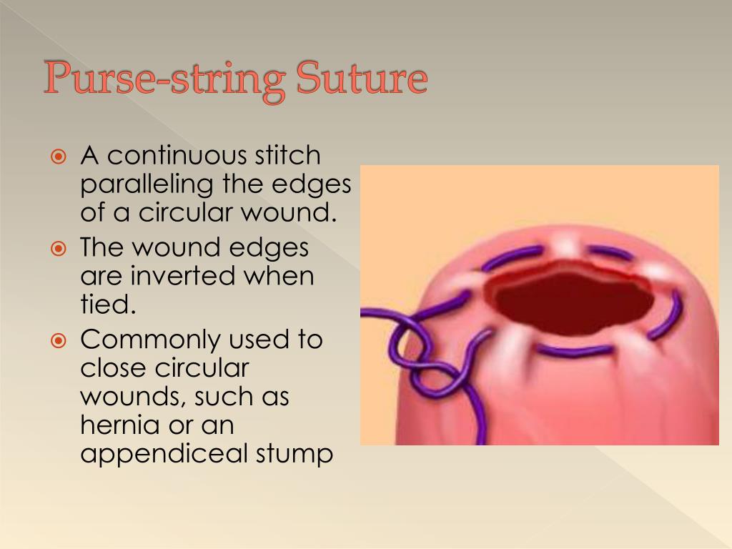 Inverted Nipple Correction Using a Combination of the Perpendicular Suture  Method and the Purse-String Suture Method