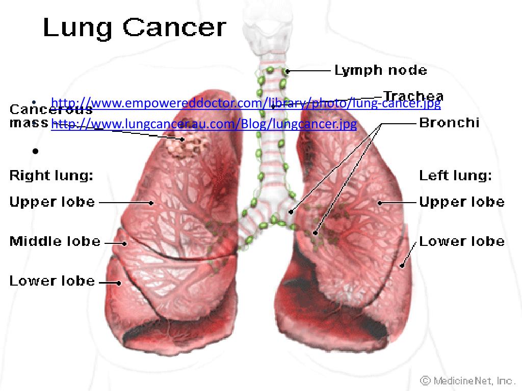PPT - Lung Cancer PowerPoint Presentation, free download - ID:2798449