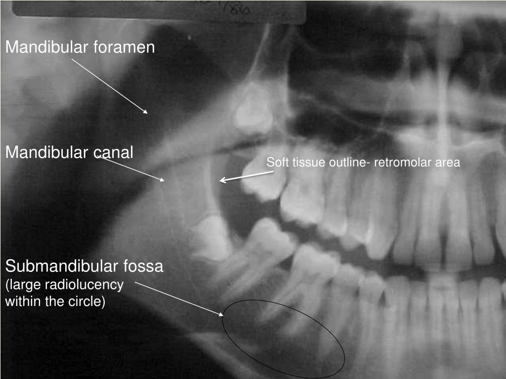 PPT And Their Radiographic Appearance PowerPoint Presentation Free 