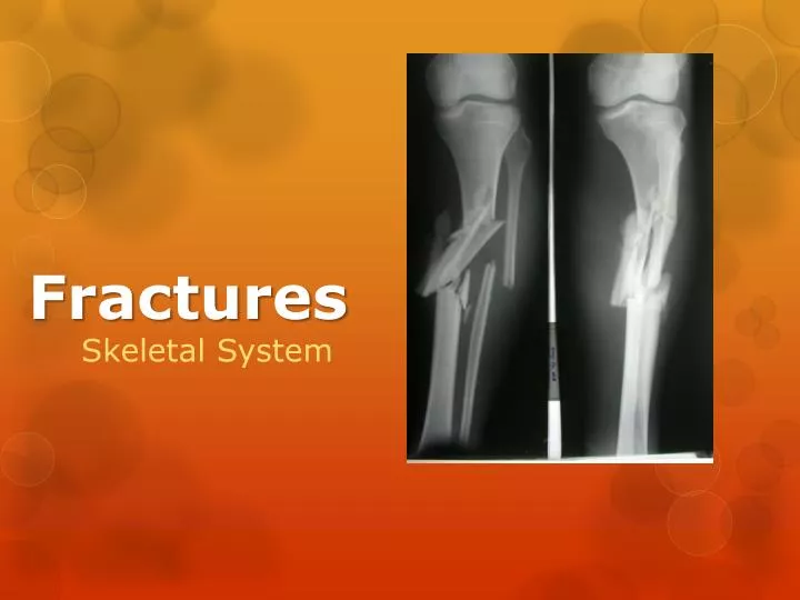 case study on fracture ppt