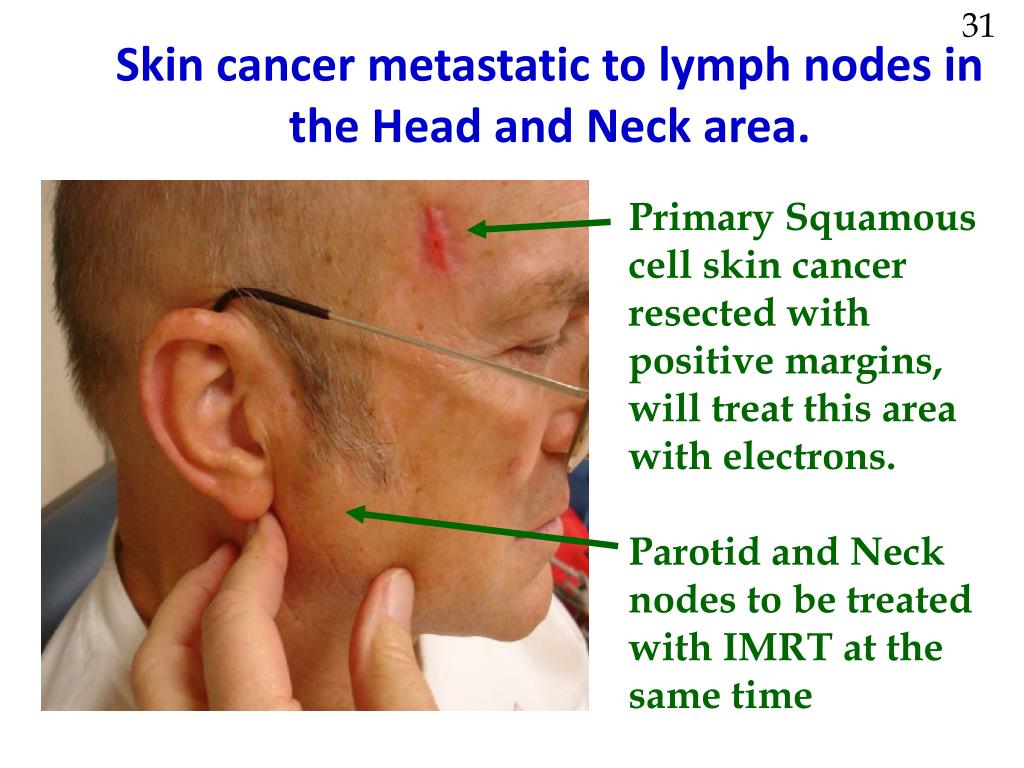 Metastatic cancer neck icd 10, Metastatic cancer neck icd Neoplasm - Wikipedia