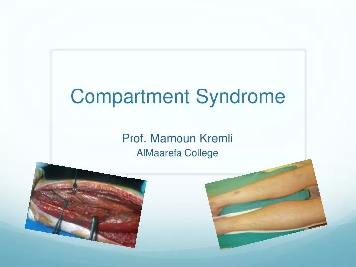PPT Compartment Syndrome PowerPoint Presentation, free download ID