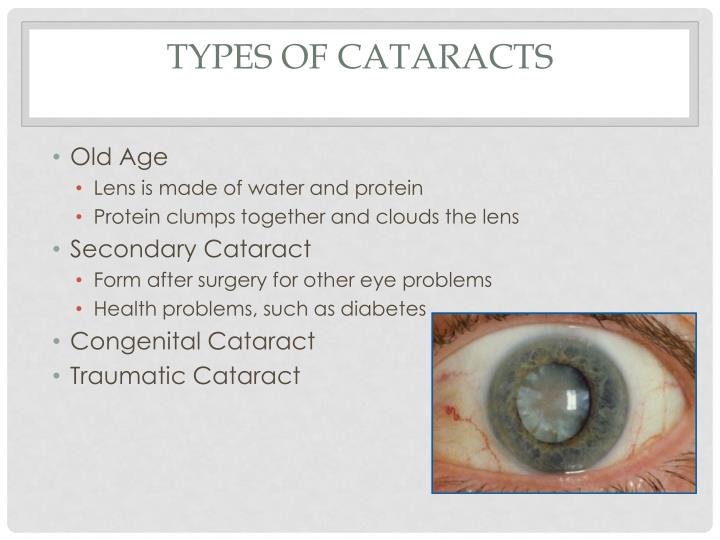 Ppt Cataract Powerpoint Presentation Id2823305