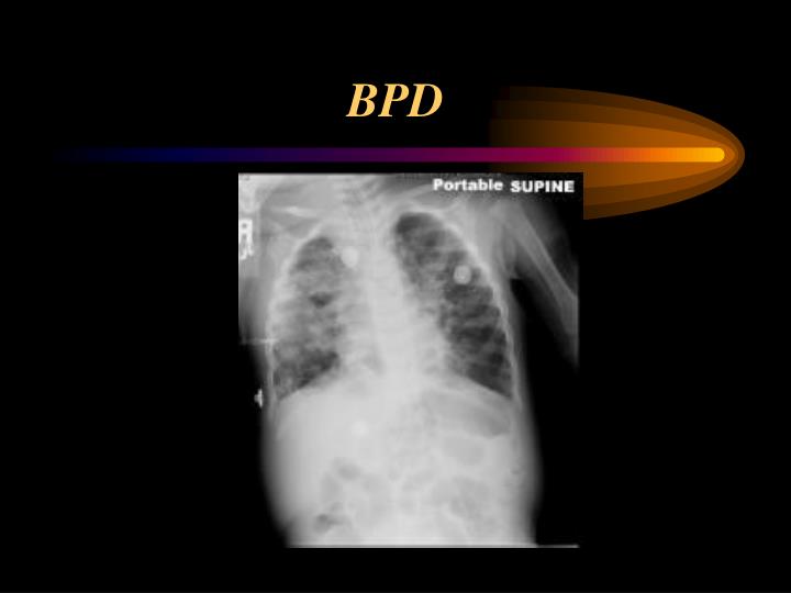 chest reading ray neonatal bpd powerpoint rays ppt presentation slideserve