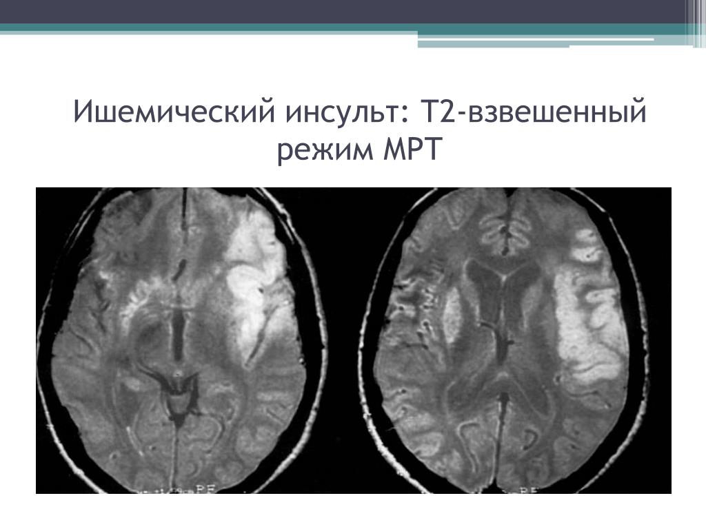 Ишемические изменения головного мозга. Геморрагический инсульт мрт т1. Мрт ишемический инсульт т1. Ишемия головного мозга мрт т2. Ишемический инсульт кт.
