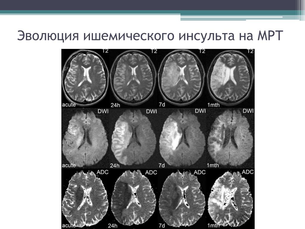 Ишемия мозга мрт. Ишемический инсульт мрт Dwi. Подострая стадия ишемического инсульта мрт. Подострый ишемический инсульт на мрт. Геморрагический инсульт кт.