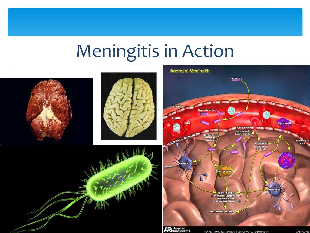 presentation slide meningitis