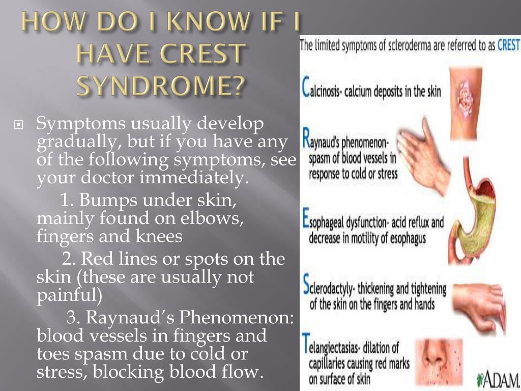 PPT - CREST SYNDROME (Limited Scleroderma) PowerPoint Presentation