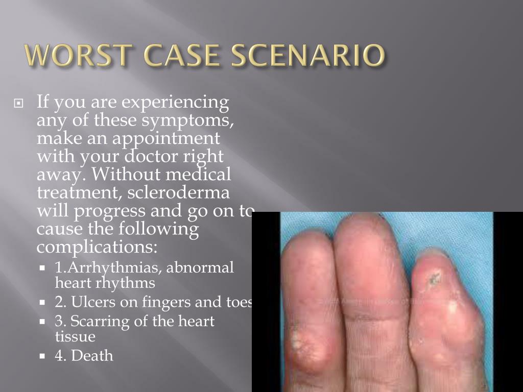 PPT - CREST SYNDROME (Limited Scleroderma) PowerPoint Presentation