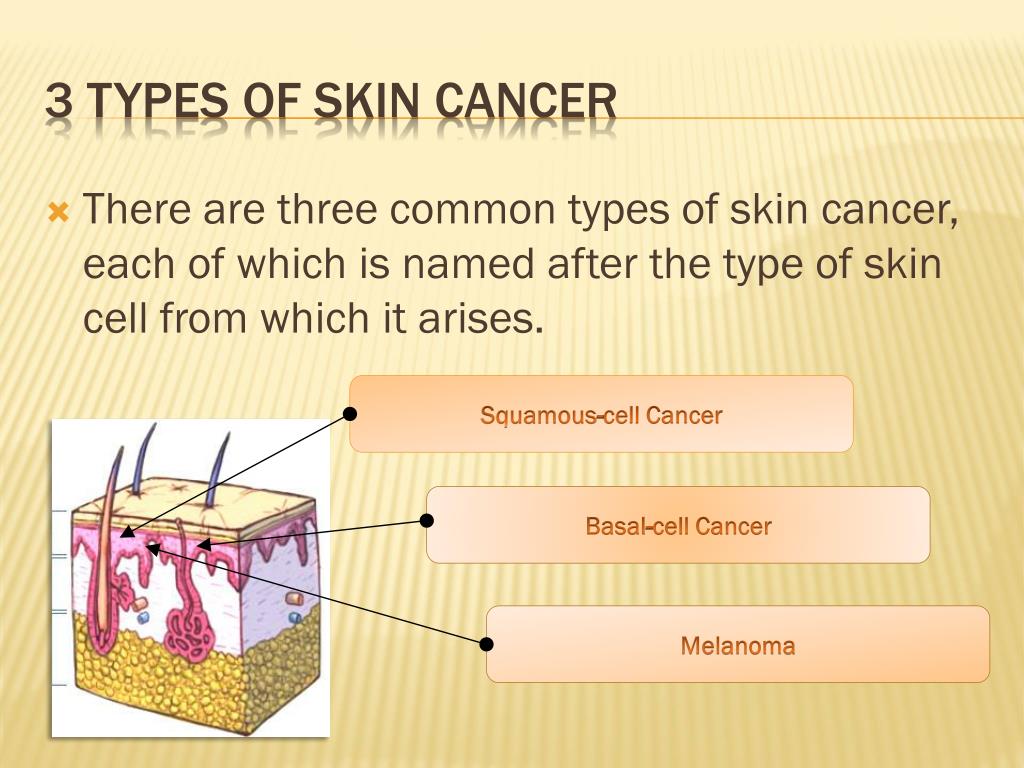 PPT - Skin Cancer PowerPoint Presentation, free download - ID:2849715