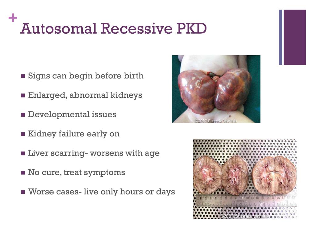 age of presentation polycystic kidney disease