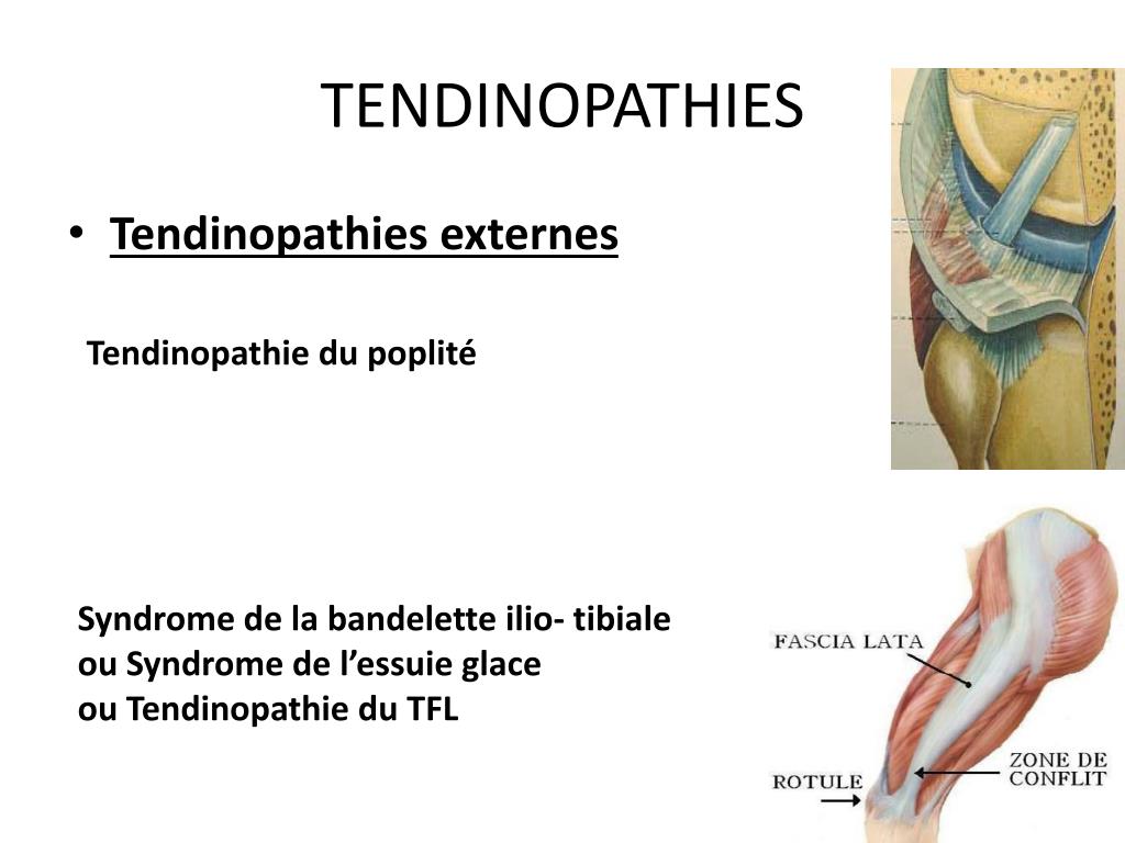 PPT - TENDINOPATHIE DU GENOU PowerPoint Presentation, free download ...