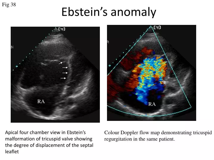ebsteins anomaly