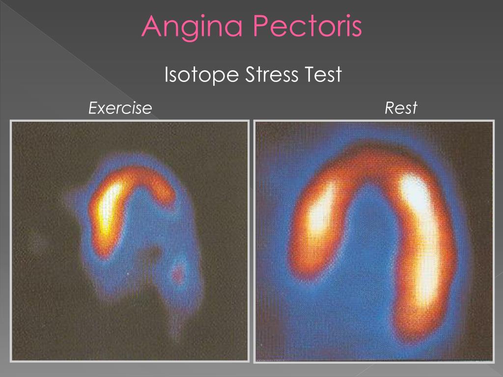 Test Angina Angina Stress Test : Mayo Clinic Q and A: Chest pain despite normal ...