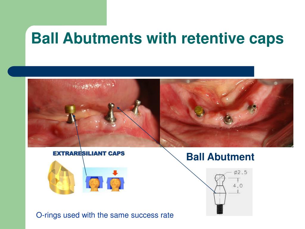PPT Almitech Implant System for implant retained overdentures
