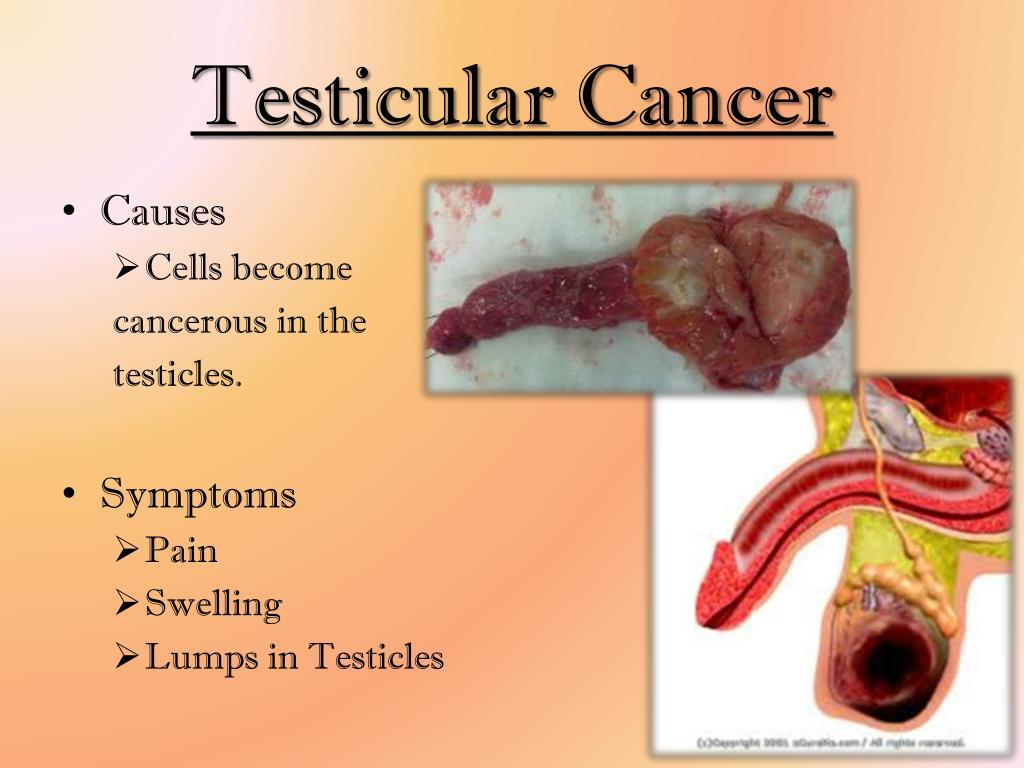 Epididymitis Lump epididymitis-lump