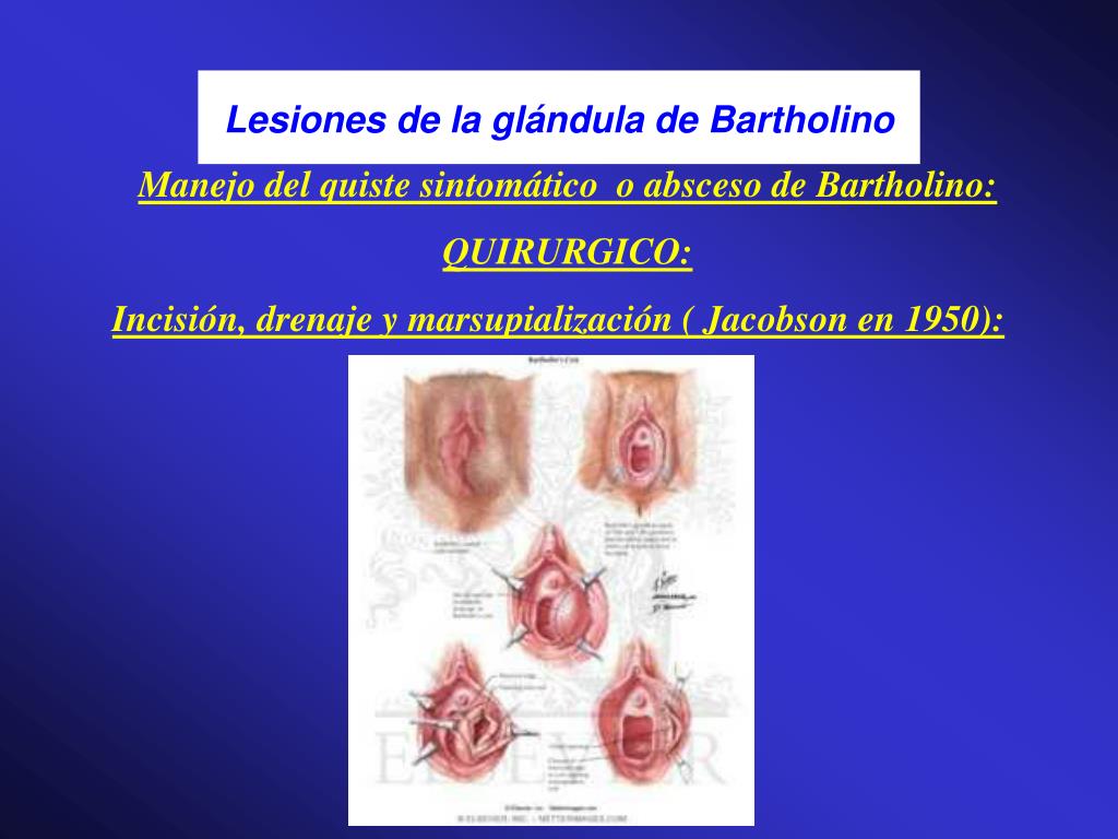Como Desinchar A Glândula De Bartholin