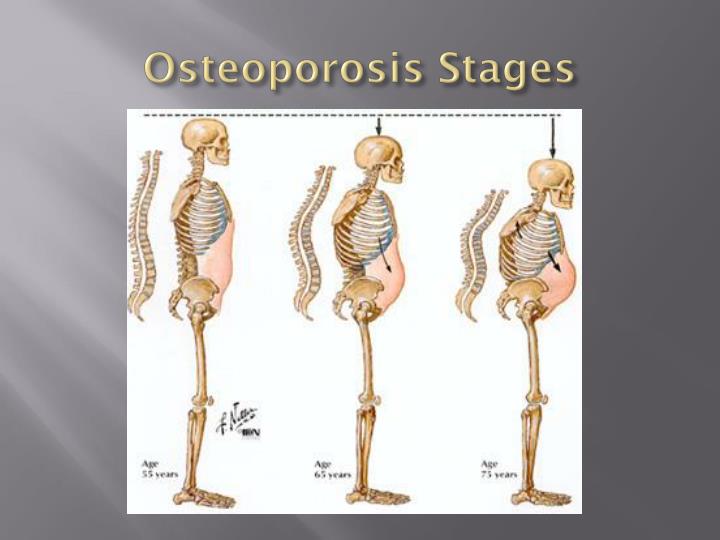 5 Stages Of Osteoporosis