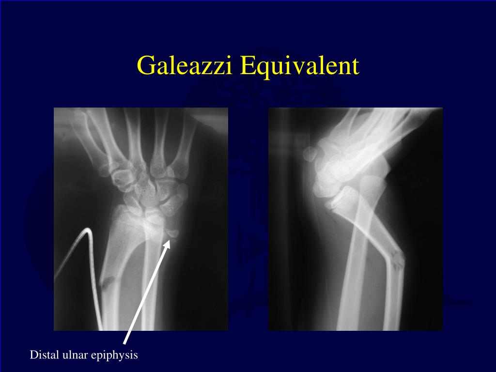 galeazzi fracture healing time galeazzi fracture healing time