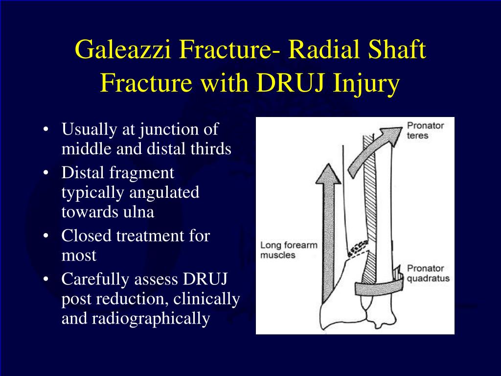 ao classification of galeazzi fracture ao classification of galeazzi fracture