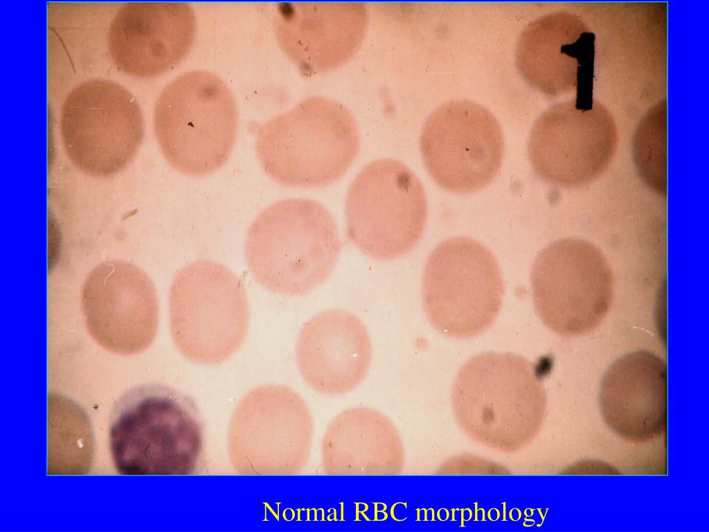 PPT - Dr. Judit Demeter Semmelweis Egyetem ÁOK., I.sz. Belgyógyászati ...