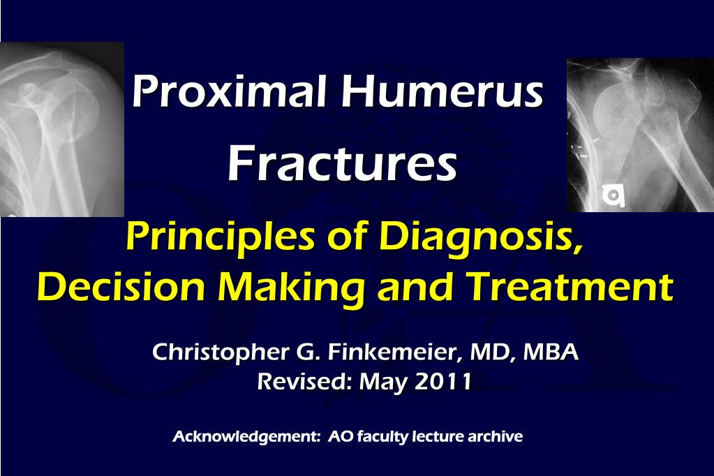 proximal humerus fracture presentation