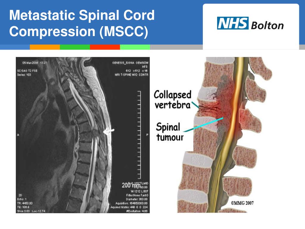 PPT - Identifying Spinal Cord Compression - Key Red Flags PowerPoint