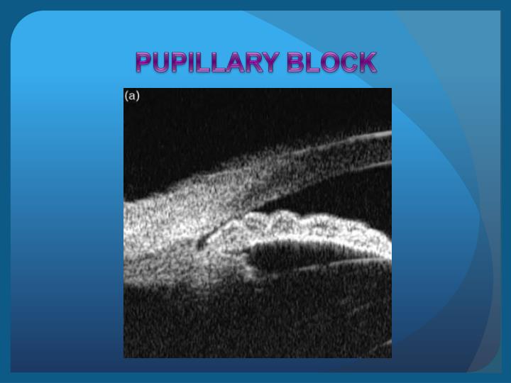 PPT - UBM Ultrasound Biomicroscopy PowerPoint Presentation - ID:2954068