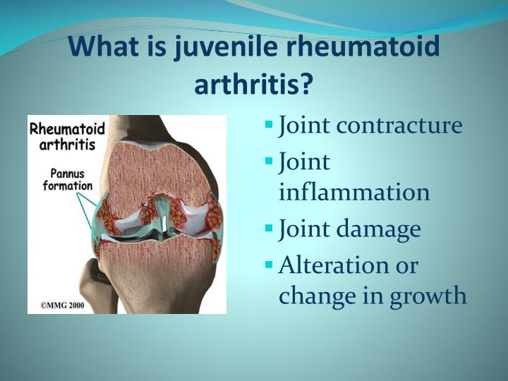 PPT Normal knee anatomy Symptoms and pathology of juvenile rheumatoid arthritis Pain