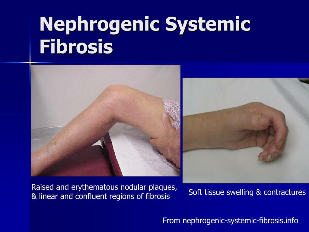 PPT Chronic Kidney Disease CKD In The Hospitalized Patient 