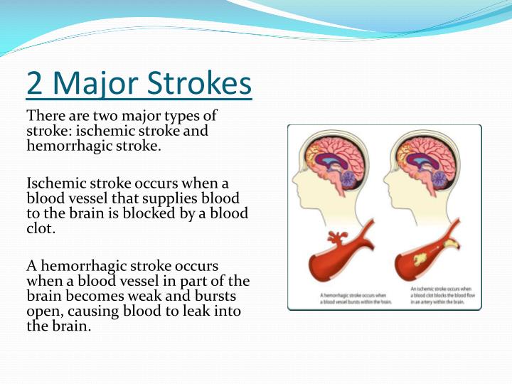 PPT - Cerebrovascular Accident (Stroke) PowerPoint Presentation - ID