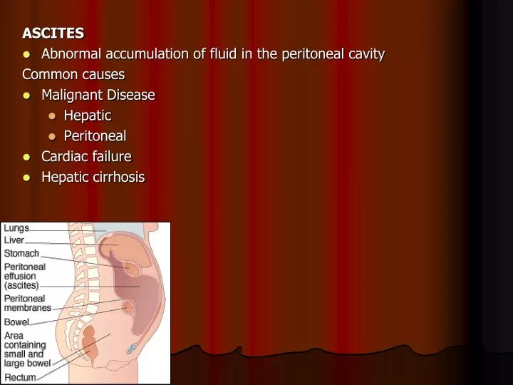 case presentation of ascites ppt