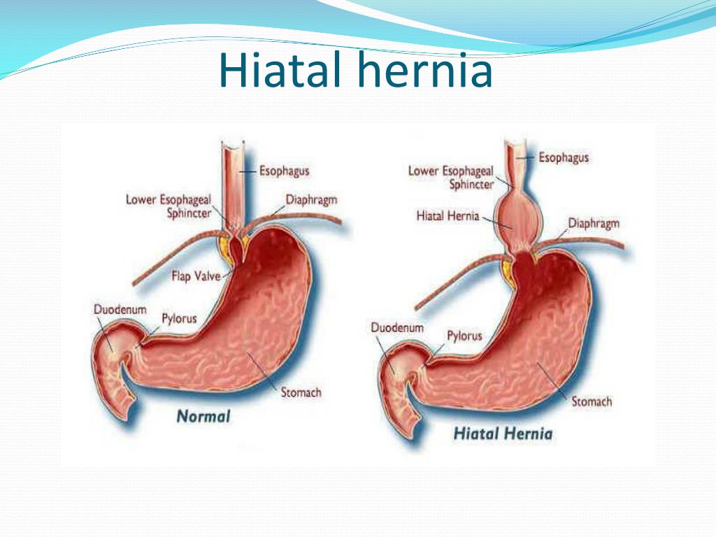 PPT - hernia PowerPoint Presentation, free download - ID:2957512